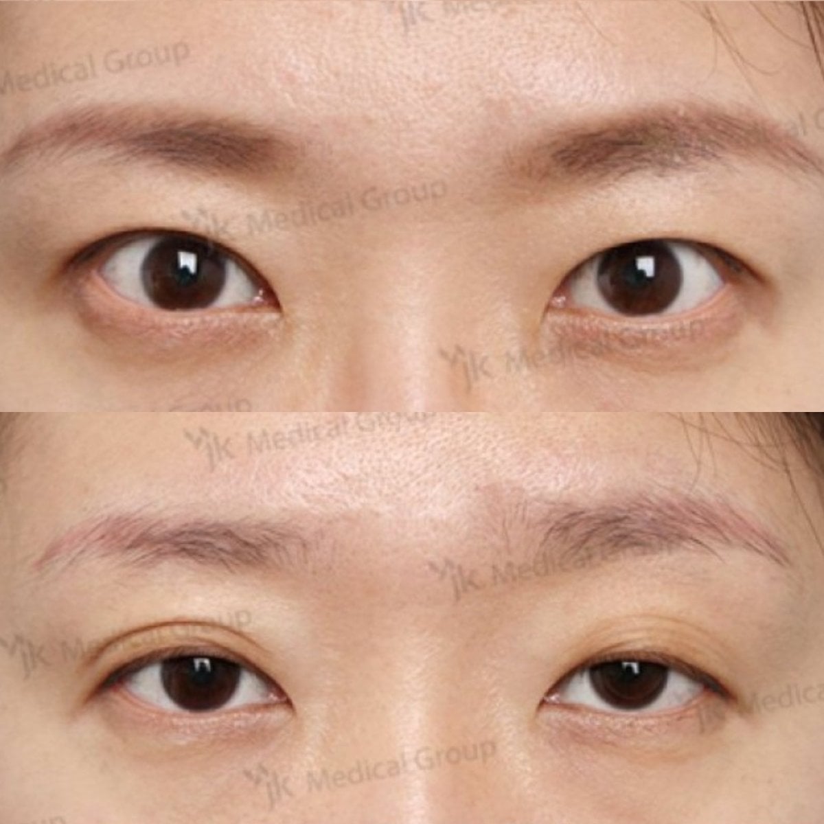 نتائج قبل وبعد جراحة الجفن الكسول في JK Plastic Surgery Center، تحسين شكل الجفن