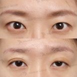 Vorher-nachher-Ergebnis der Lazy-Eyelid-OP im JK Plastic Surgery Center, verbesserte Lidkontur