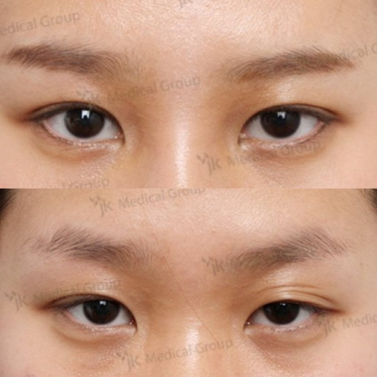 نتائج قبل وبعد جراحة الجفن الكسول في مركز JK Plastic Surgery، تحسين شكل الجفن