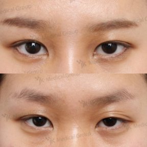 Vorher-nachher-Ergebnis der Lazy Eyelid Surgery im JK Plastic Surgery Center, verbesserte Lidkontur