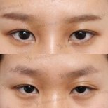 Vorher-nachher-Ergebnis der Lazy Eyelid Surgery im JK Plastic Surgery Center, verbesserte Lidkontur