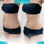 نتائج شفط الدهون 360 قبل وبعد في مستشفى وانسيري، تحسين محيط الخصر