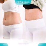 نتائج شفط الدهون 360 قبل وبعد في مستشفى وانسيري، تحسين شكل البطن