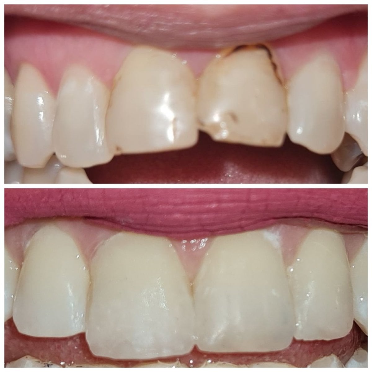 نتائج قبل وبعد ترابط الأسنان في SoftDentalCare Clinic للأسنان الأمامية المكسورة