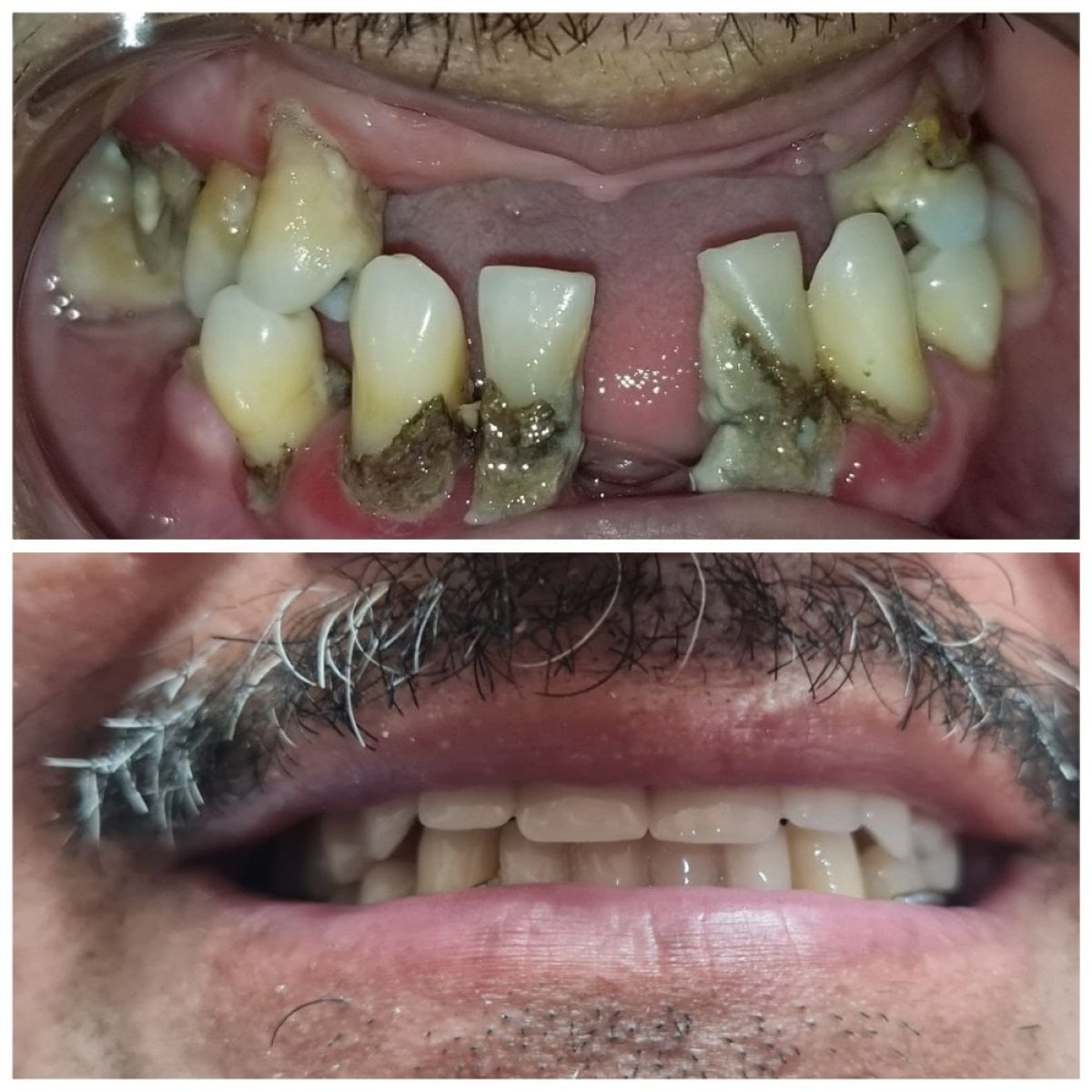 قبل وبعد تركيب أطقم الأسنان الفورية في SoftDentalCare Clinic، ابتسامة مستعادة
