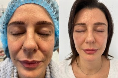 Vorher-nachher-Ergebnis Unterlid-Blepharoplastik, sichtbare Verjüngung unter den Augen