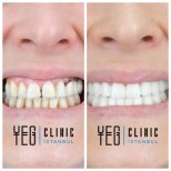Before and after All-on-6 dental implants result at YEG Clinic – full smile restoration