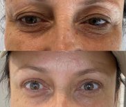 Vorher-nachher-Ergebnis der Blepharoplastik in der Dr. Safa Manav Klinik, Lidkorrektur