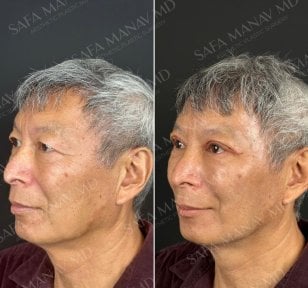 Vorher-nachher-Ergebnis der Blepharoplastik in der Dr. Safa Manav Klinik, Lidkorrektur