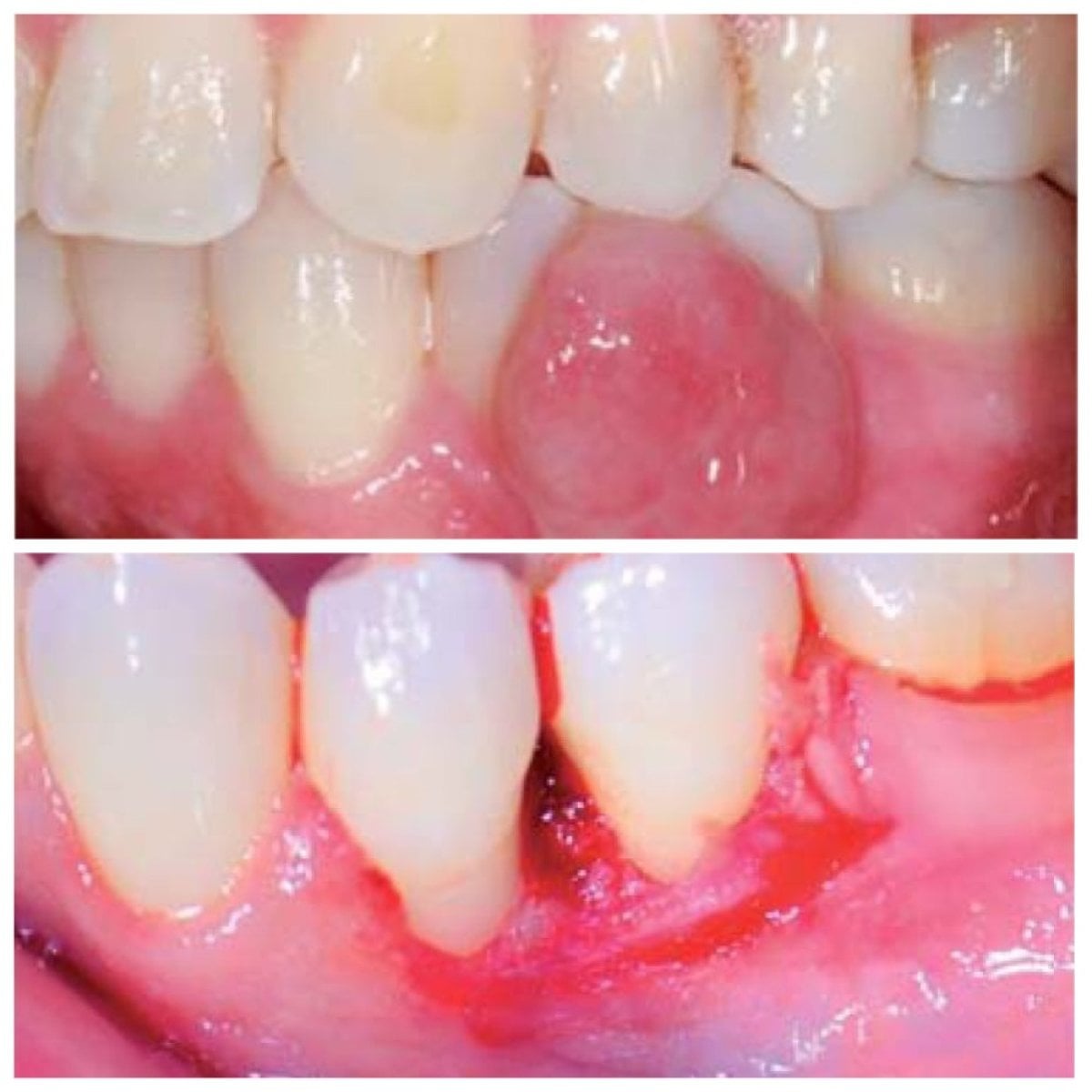 نتائج قبل وبعد جينجيفيكتومي في SoftDentalCare Clinic – تحسين شكل اللثة