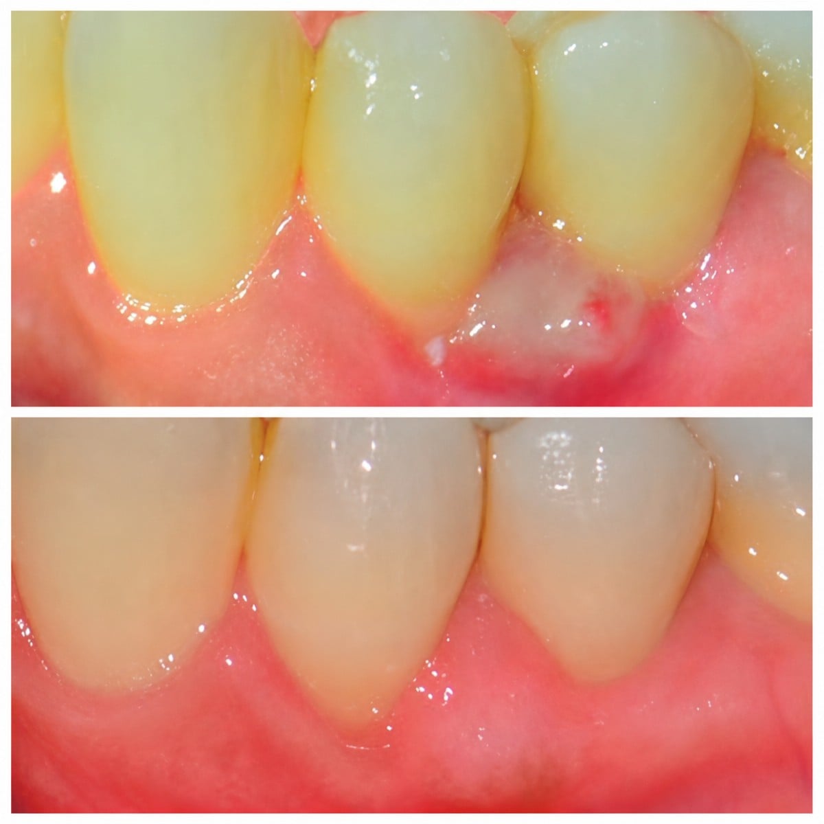 نتائج قبل وبعد جينجيفكتومي في SoftDentalCare Clinic – تحسين شكل اللثة