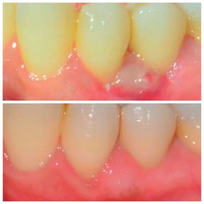 Vorher-nachher-Gingivektomie-Ergebnis bei SoftDentalCare Clinic – verbesserter Zahnfleischrand
