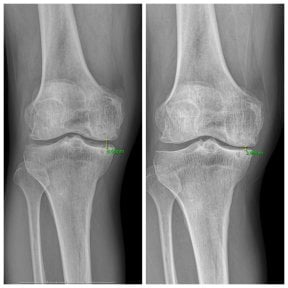 Before and after stem cell therapy for knees at samsungbalance clinic, improved joint space result