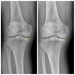 Before and after stem cell therapy for knees at samsungbalance clinic, improved joint space result