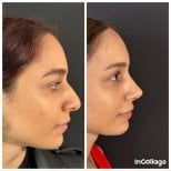 صور قبل وبعد جراحة الأنف (انظر عملية تجميل الأنف) للدكتور 