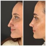 صور قبل وبعد جراحة الأنف (انظر عملية تجميل الأنف) للدكتور 