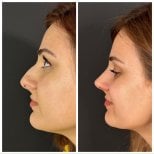 صور قبل وبعد جراحة الأنف (انظر عملية تجميل الأنف) للدكتور 