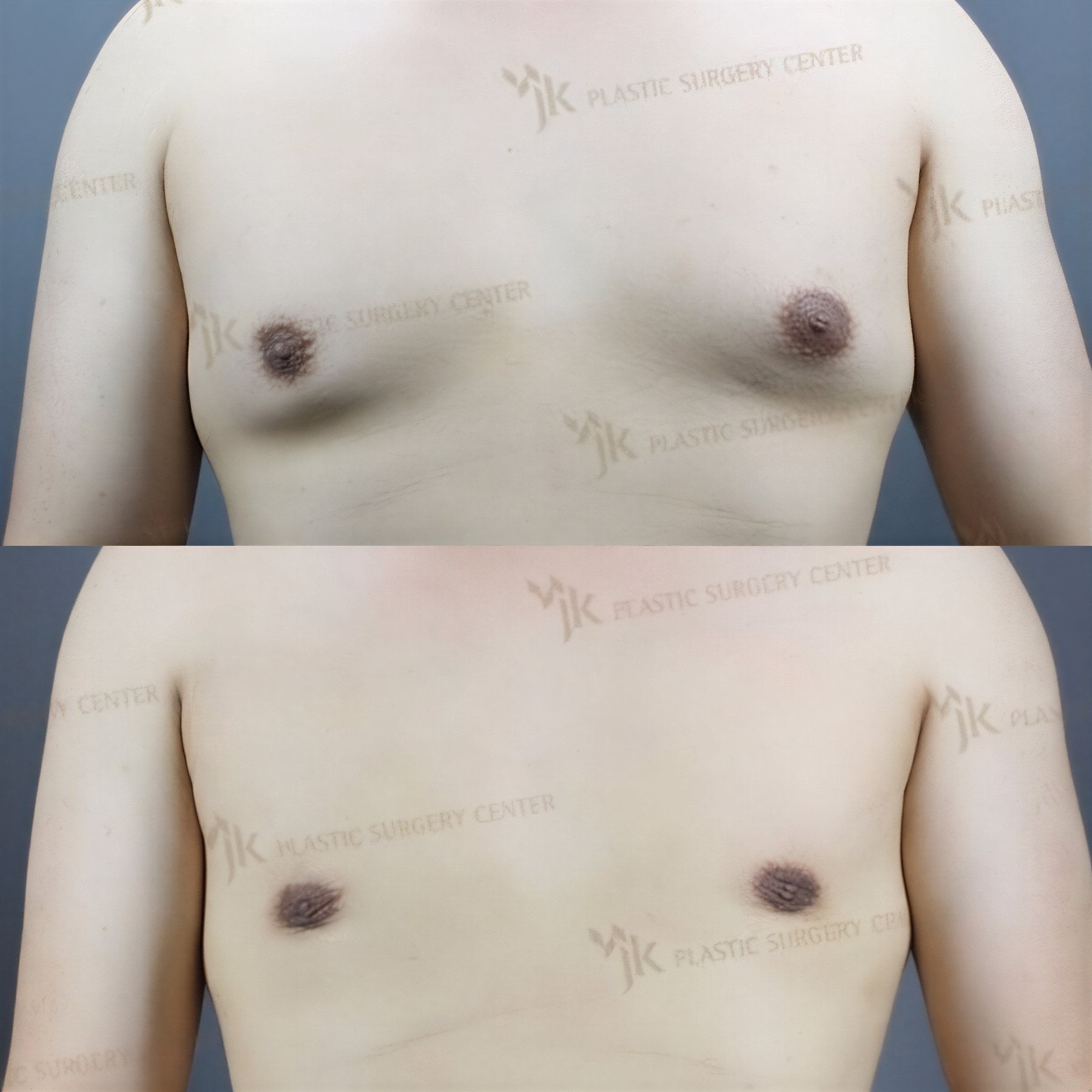 Resultados antes y después de cirugía de ginecomastia en JK Plastic Surgery Center, contorno de pecho