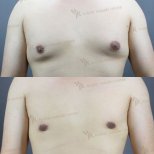 Vorher-nachher-Ergebnis der Gynäkomastie-OP im JK Plastic Surgery Center, Brustkontur