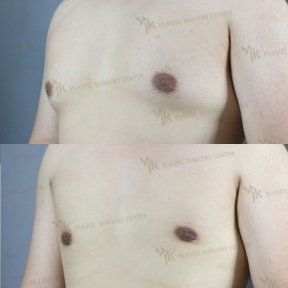 Vorher-nachher-Ergebnisse der Gynäkomastie-OP im JK Plastic Surgery Center, flache Brust