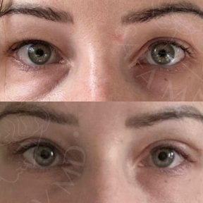 Vorher-nachher-Ergebnis der Blepharoplastik in der Dr. Safa Manav Klinik, Lidkorrektur