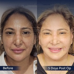 Facelift before and after results at Dr. Safa Manav Clinic, visible facial rejuvenation
