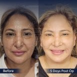 Facelift before and after results at Dr. Safa Manav Clinic, visible facial rejuvenation