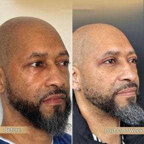 Blepharoplastik Vorher-Nachher-Ergebnis in der Dr. Safa Manav Klinik, Lidkorrektur