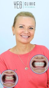 Before and after All-on-6 dental implants result at YEG Clinic, improved smile transformation