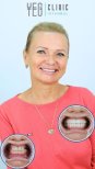 Before and after All-on-6 dental implants result at YEG Clinic, improved smile transformation