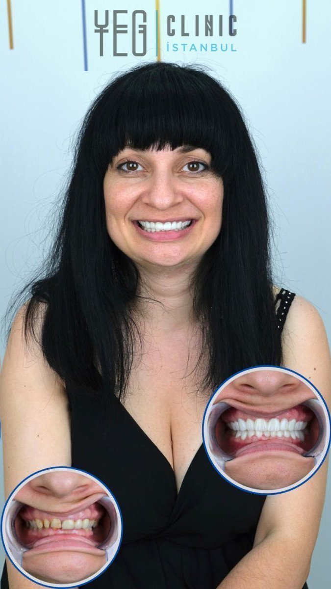 نتائج زراعة الأسنان الفورية في YEG Clinic – تحسين جمالية الابتسامة