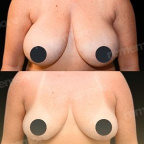 نتائج شد الثدي قبل وبعد في مستشفى ميموريال أنطاليا، تحسين شكل الثدي