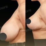 نتائج شد الثدي قبل وبعد في مستشفى ميموريال أنطاليا، تحسين شكل الثدي