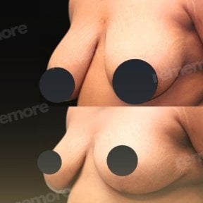 نتائج شد الثدي قبل وبعد في مستشفى ميموريال أنطاليا، تحسين شكل الثدي