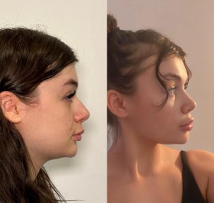 Vorher-nachher-Ergebnis der Nasenkorrektur in der Dr. Safa Manav Klinik, natürliche Form