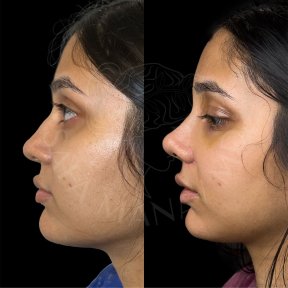 Vorher-nachher-Rhinoplastik-Ergebnis in der Dr. Safa Manav Klinik, Nasenkorrektur