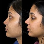 Vorher-nachher-Rhinoplastik-Ergebnis in der Dr. Safa Manav Klinik, Nasenkorrektur
