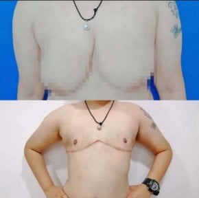 Before and after top surgery results at ID Clinic Bangkok, chest masculinization transformation
