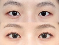 Vorher-nachher-Ergebnisse der Blepharoplastik bei AB PLASTIC SURGERY, Lidkorrektur