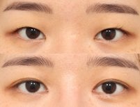 Vorher-nachher-Ergebnis der Blepharoplastik bei AB PLASTIC SURGERY, Lidkorrektur