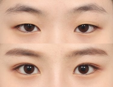 Vorher-nachher-Ergebnis der Blepharoplastik bei AB PLASTIC SURGERY, natürliche Lidkorrektur