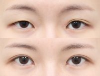 Blepharoplastik Vorher-Nachher-Ergebnis bei AB PLASTIC SURGERY, Lidkorrektur