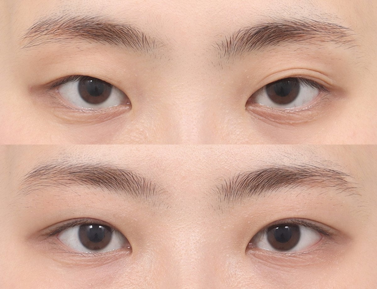 نتائج رأب الجفن قبل وبعد في AB PLASTIC SURGERY، تصحيح الجفون