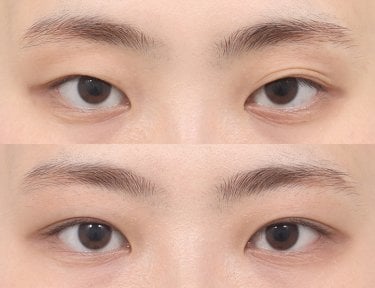 Vorher-nachher-Ergebnis der Blepharoplastik bei AB PLASTIC SURGERY, Lidkorrektur