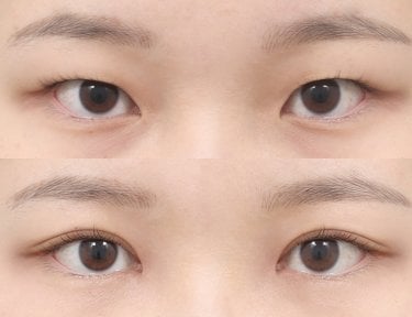 Результаты блефаропластики до и после в AB PLASTIC SURGERY, коррекция век