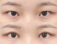 Результаты блефаропластики до и после в AB PLASTIC SURGERY, коррекция век