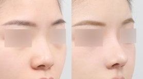 Before and after rhinoplasty results at AB PLASTIC SURGERY, nose reshaping for natural look