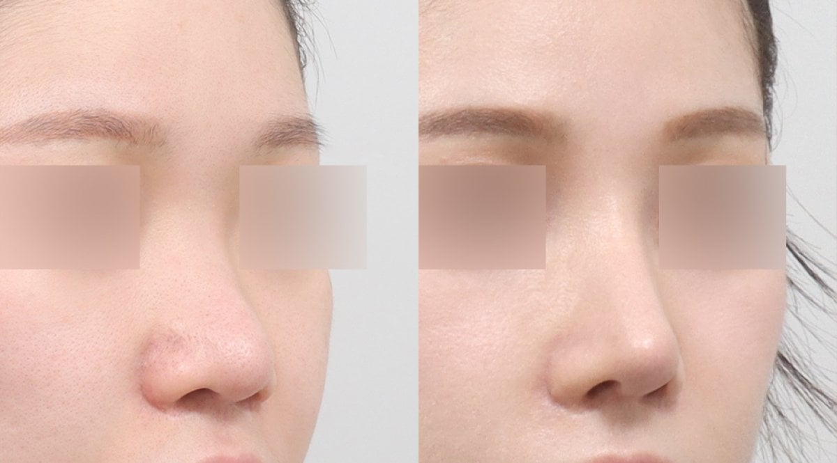 نتائج عملية تجميل الأنف قبل وبعد في AB PLASTIC SURGERY، إعادة تشكيل طبيعية للأنف