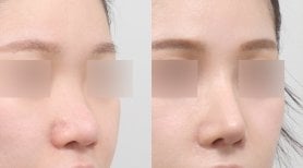 Vorher-nachher-Rhinoplastik-Ergebnisse bei AB PLASTIC SURGERY, natürliche Nasenkorrektur