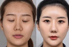 Face contouring before and after results, visible jawline and cheek enhancement